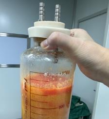 喀什水动力吸脂手术要做多久？